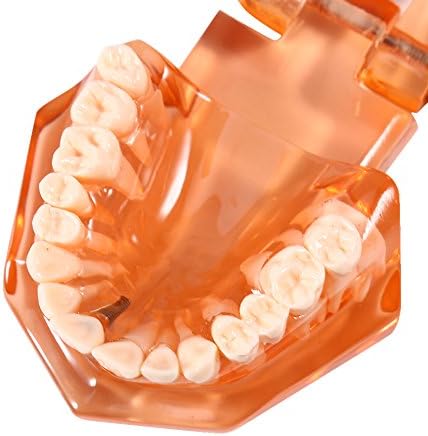 מודל שיניים, שיניים ניתנות לשיניים דגם השתל לימוד לימוד שיניים, צבע כתום