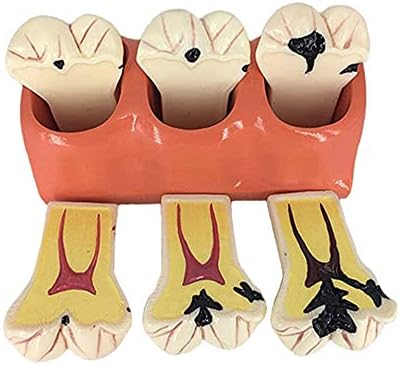 מודל אנטומיה של קינופו, מודל שיניים שיניים מודל חינוך מטופלים מודל עששת פירוק מודל שיניים, עששת שיניים מפרקת מודל