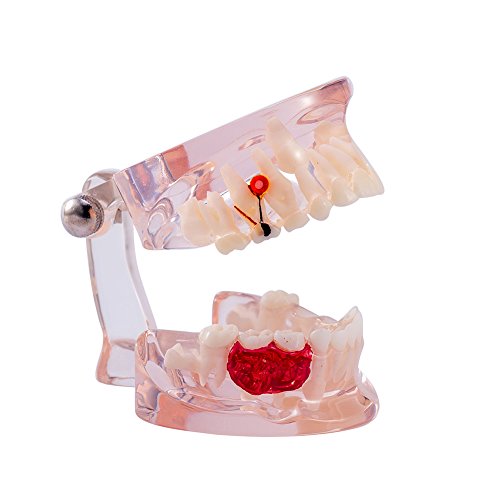 לימוד שיניים שיניים של Easysmile מודל הוראה בהוראה מודל שיניים מעורב ברור עם מודל פתולוגי שיניים חסר לחינוך שיניים